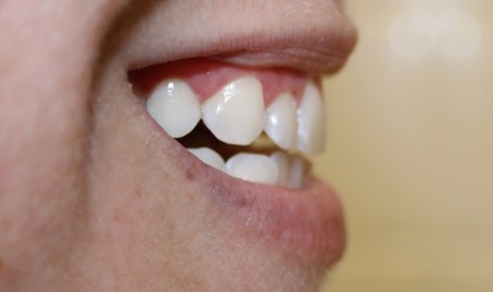 After Whitening - Amy Lee Creel